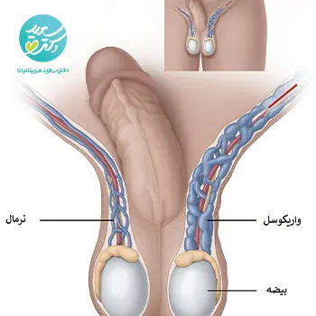 پودر واریکوسل