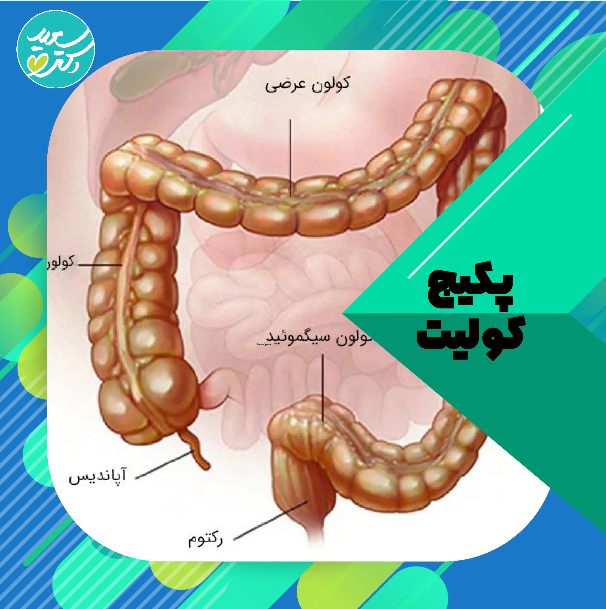 پکیج درمان کولیت