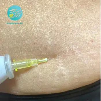 رفع ترک های پوستی با کربوکسی تراپی