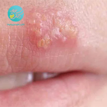 پکیج تبخال (صورت)