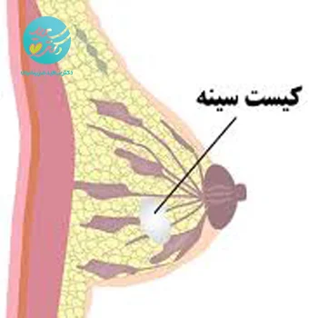 پکیج کیست پستان