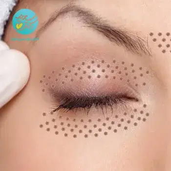 رفع مشکلات دور چشم با پلاسما تراپی