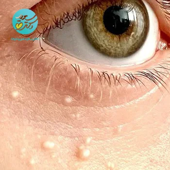 پکیج درمان میلیا(دانه های سفید دور چشم و صورت)