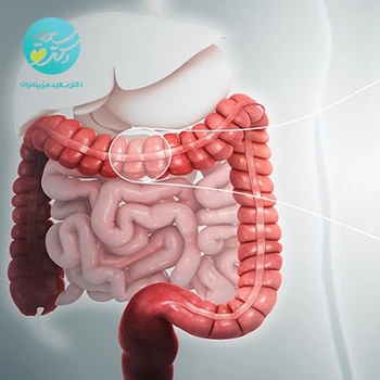 پودر کولیت و روده تحریک پذیر
