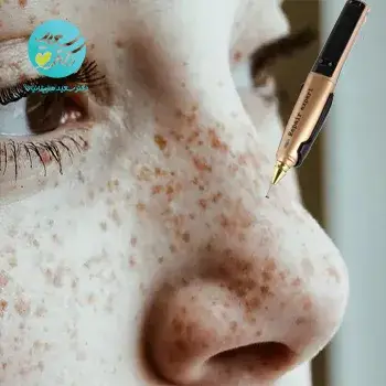 رفع لک، کک و مک با پلاسما تراپی