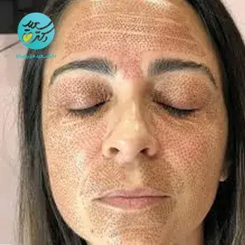 رفع افتادگی پوست و لیفت صورت با پلاسما تراپی
