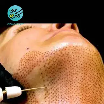 رفع غبغب با کربوکسی تراپی