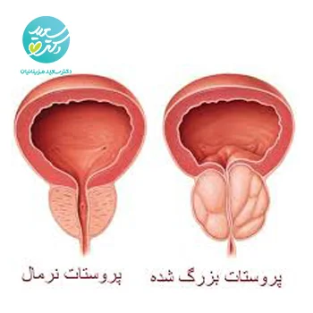 پکیج بزرگی پروستات
