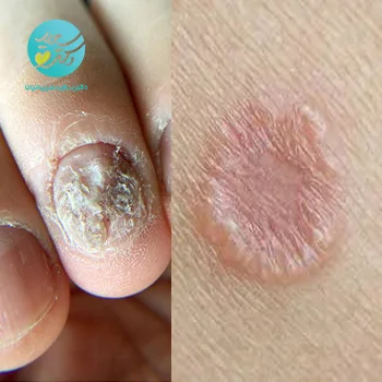 پکیج قارچ پوست و ناخن