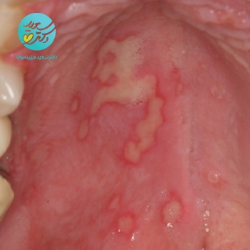 پکیج زخم های دهانی