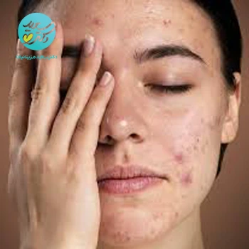 پکیج ضد جوش و ترمیم جای جوش