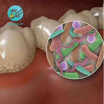 پکیج  عفونت دهان و دندان