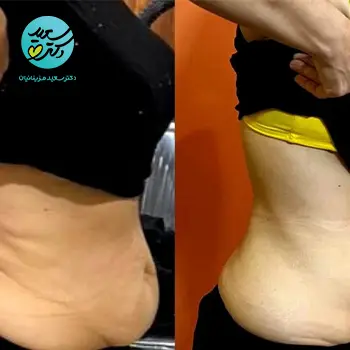 ژل کوچک کننده موضعی کل بدن