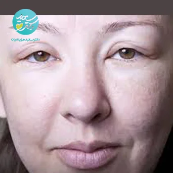 پکیج ورم صورت و بدن