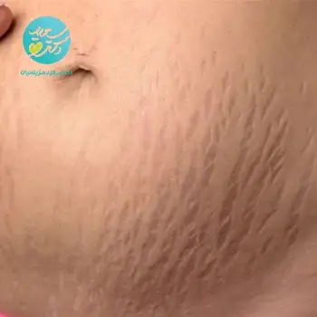 پکیج استریا