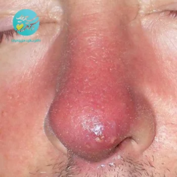 پکیج عفونت بینی