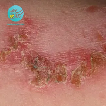 پکیج عفونت پوستی