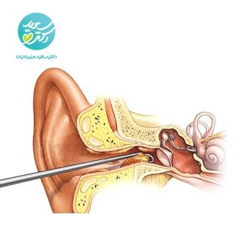 پکیج  جرم زیاد گوش