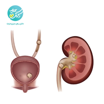 پکیج سنگ کلیه و مثانه