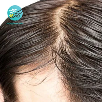 پکیج موهای چرب