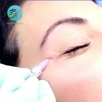 رفع افتادگی پلک با کربوکسی تراپی