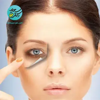 رفع مشکلات دور چشم با کربوکسی تراپی