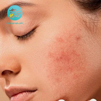 پکیج ضد لک صورت