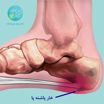 پکیج خار پاشنه