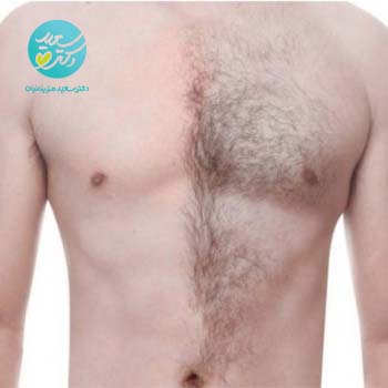 پکیج موهای زائد صورت و بدن