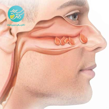 پکیج پولیپ و کیپی بینی