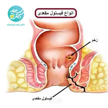 پکیج فیستول مقعدی