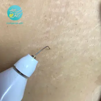 رفع ترک های پوستی با پلاسما تراپی