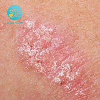 پکیج پسوریازیس