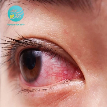 پکیج آلرژی و حساسیت چشم