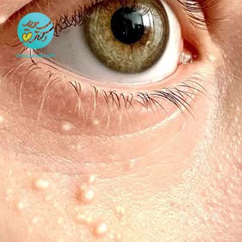 پکیج درمان میلیا(دانه های سفید دور چشم و صورت)