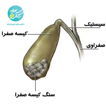 پکیج سنگ صفرا