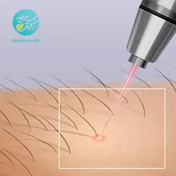 لیزر صورت آقایان