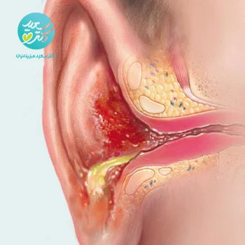 پکیج عفونت گوش