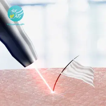 لیزر ساعد آقایان