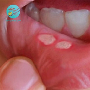 پکیج آفت  دهان