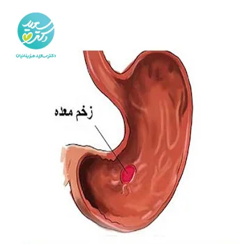 پکیج درد و زخم معده