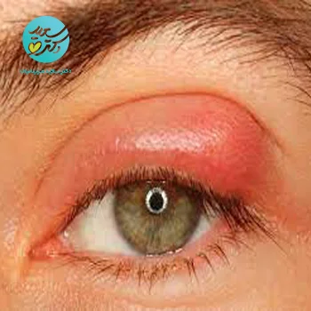 پکیج عفونت چشم