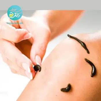 زالو (1تا 5عدد)