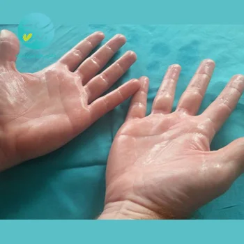 پکیج تعریق کف دست و پا