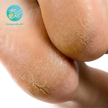 محلول ترک دست و پا