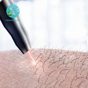 لیزر بیکینی بانوان