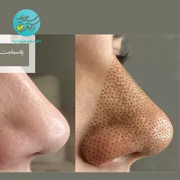 کوچک کردن بینی با پلاسما تراپی