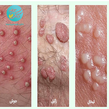 پماد زگیل تناسلی