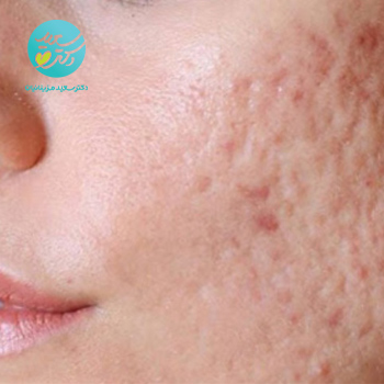 پکیج ضد جوش و ترمیم جای جوش