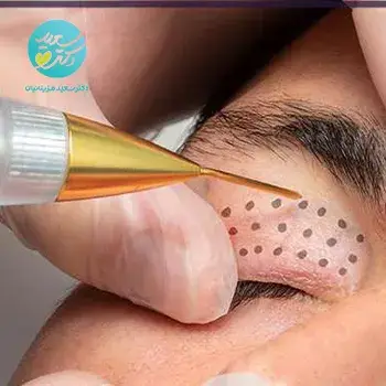 رفع افتادگی پلک با پلاسما تراپی